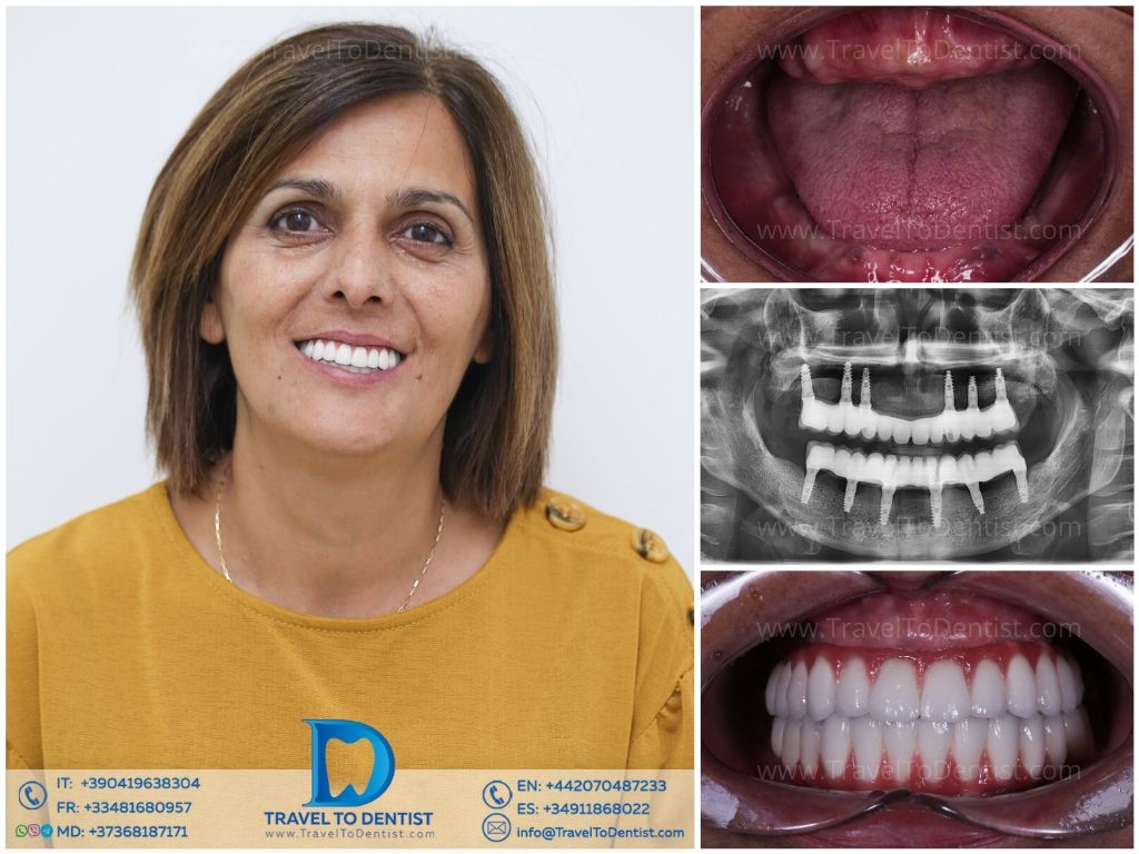 Caso clínico 5 – Resultado estético dental
